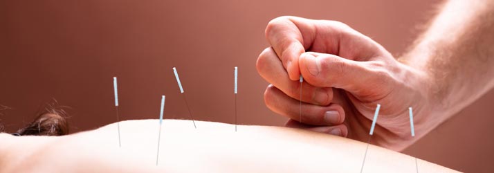 Chiropractic Columbia MO Prepare for Acupuncture Chiropractic Columbia MO Prepare for Acupuncture